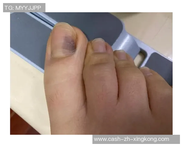 足球鞋穿戴不当导致脚趾淤血的原因及预防措施解析